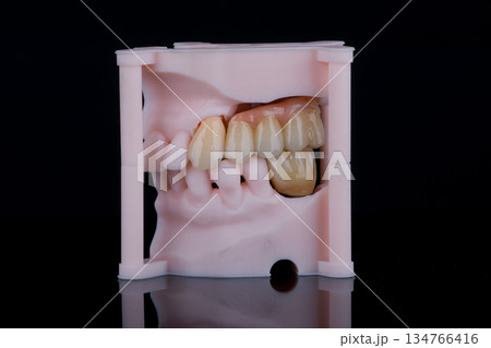 Dental bridge of three teeth made of monolithic zirconia for fixation on implants. Artificial teeth on printed models. 134766416