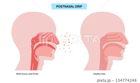 Postnasal drip poster 134774249