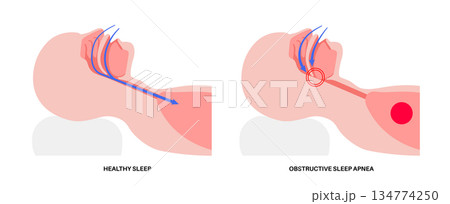 Obstructive sleep apnea Obstructive sleep apnea 134774250