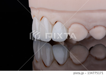 Four dental ultra-thin ceramic veneers in bleach color for fixation to frontal teeth of upper jaw. Four dental ultra-thin ceramic veneers in bleach color for fixation to frontal teeth of upper jaw. 134775171