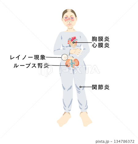 全身性エリテマトーデス（SLE）の症状を示す医療イラスト｜蝶形紅斑・関節炎・ループス腎炎 134786372
