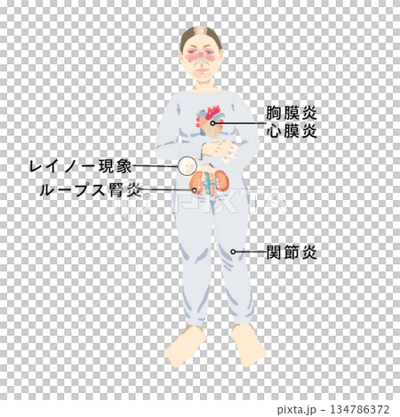 Medical illustration showing symptoms of systemic lupus erythematosus (SLE): erythema varicella, arthritis, lupus nephritis 134786372