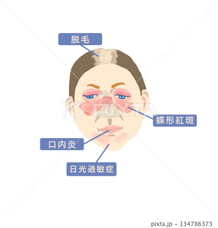 全身性エリテマトーデス（SLE）の症状を示す医療イラスト｜蝶形紅斑・関節炎・ループス腎炎 134786373