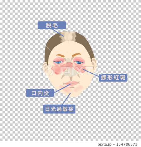 全身性エリテマトーデス（SLE）の症状を示す医療イラスト｜蝶形紅斑・関節炎・ループス腎炎 134786373