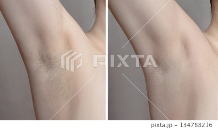 A collage of two photos of a woman's armpit. Armpit with long hair and armpit for hair removal. After epilation and depilation close up photo 134788216