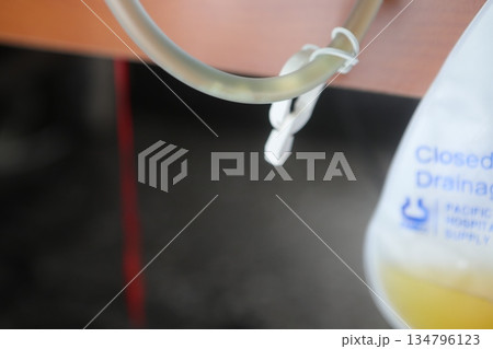 蛋白尿 蛋白尿 134796123