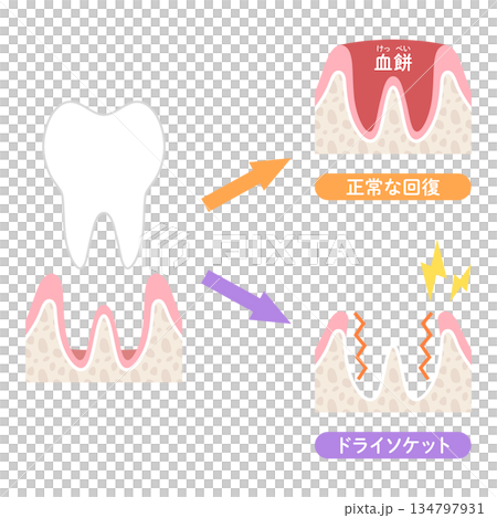 Normal recovery and dry socket after tooth extraction 134797931