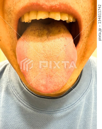 舌苔が付いた中高年の男性の舌 舌苔が付いた中高年の男性の舌 134811742