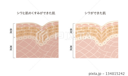 シワとくすみ シワとくすみ 134815242