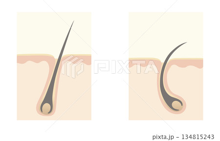 毛髪の生え方 134815243