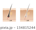健康な毛髪と痩せた毛髪 134815244