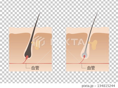 健康な毛髪と痩せた毛髪 134815244