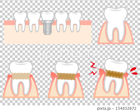 牙周病牙齦與牙齒插畫材料集 134832672