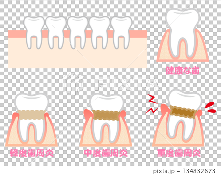 牙周病牙齦與牙齒插畫材料集 2 134832673