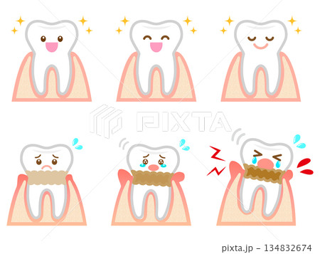 歯周病の歯茎と歯のイラスト素材セット3 134832674