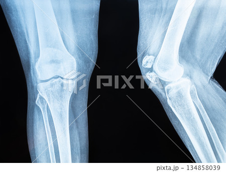 X-ray image of the knee joint. View fracture and displacement of the patella bone or knee cap X-ray image of the knee joint. View fracture and displacement of the patella bone or knee cap 134858039