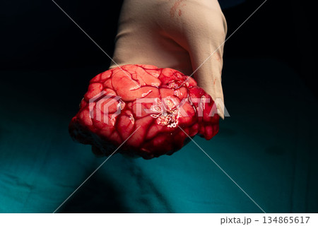 Abnormal Brain cortex causing epilepsy in Surgeon Gloved Hand Abnormal Brain cortex causing epilepsy in Surgeon Gloved Hand 134865617