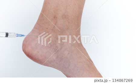 Varicose veins on leg being treated with injection, showcasing medical procedure and highlighting skin texture and condition of the affected area Varicose veins on leg being treated with injection, showcasing medical procedure and highlighting skin texture and condition of the affected area 134867269