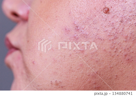 Skin face after removing hair Skin face after removing hair 134880741