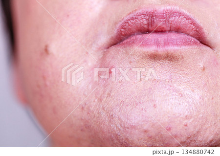 Female face with acne skin problem 134880742