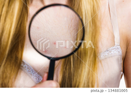 Woman with skin problem acne on neckline Woman with skin problem acne on neckline 134881005