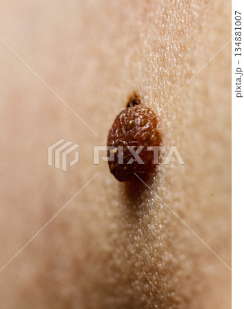 Closeup brown mole on skin. Closeup brown mole on skin. 134881007