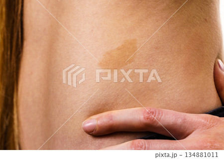 Closeup of brown birthmark on skin 134881011