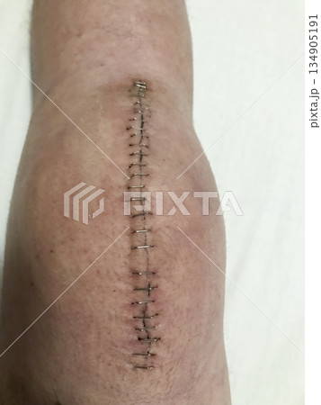A person's leg has a long scar from a recent surgery 134905191
