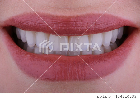 Female smile makeover by dental ceramic veneer, porcelain laminate veneers. 134910335