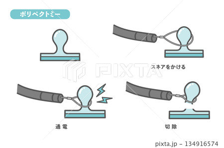 大腸ポリープ切除(ポリペクトミー)の手順・図解イラスト 大腸ポリープ切除(ポリペクトミー)の手順・図解イラスト 134916574