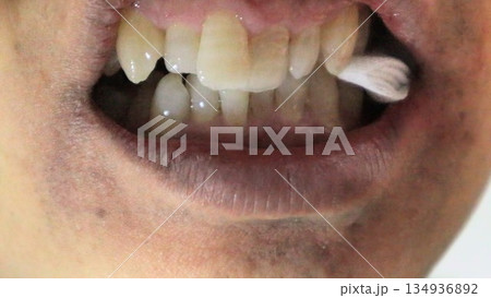 親知らず抜歯後にガーゼを噛む人物 134936892