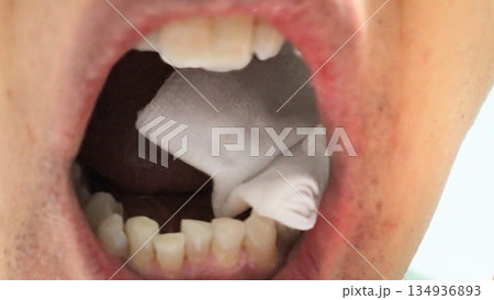 親知らず抜歯後にガーゼを噛む人物 134936893