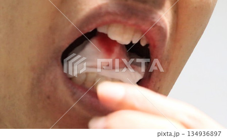 親知らずの抜歯後に噛んでいたガーゼを取りだす人物 134936897