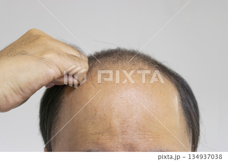 薄毛の男性の頭と手（日本人、30代） 134937038