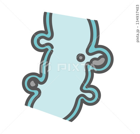 大腸憩室の断面図と便の詰まり（糞石） 134937483