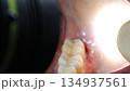 親知らずの抜歯後に抜糸した口の中 134937561