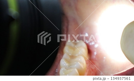 親知らずの抜歯後に抜糸した口の中 134937561