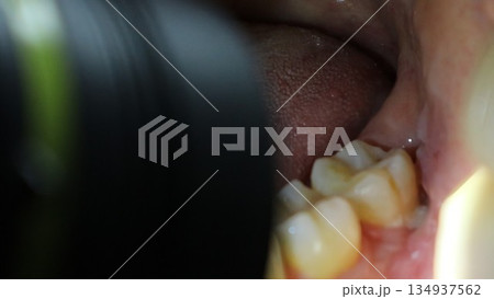 親知らず抜歯後の隙間に食べかすが挟まった状態の口の中 134937562