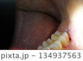 親知らずの抜歯後に抜糸した口の中 134937563