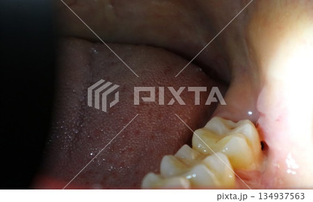 親知らずの抜歯後に抜糸した口の中 134937563