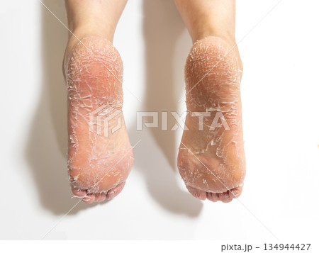 足裏の角質　角質除去　角質ケア　 134944427