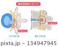 腰椎椎間板ヘルニア　椎間板の構造　腰痛 134947945
