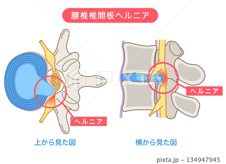 腰椎椎間板ヘルニア 椎間板の構造 腰痛 腰椎椎間板ヘルニア 椎間板の構造 腰痛 134947945
