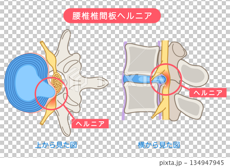 腰椎間盤突出、椎間盤結構、下背痛 134947945
