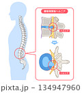 腰椎椎間板ヘルニア　椎間板の構造　腰痛 134947960
