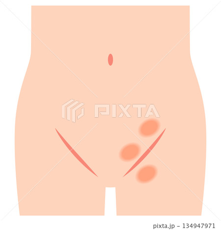 鼠径ヘルニアの種類　ヘルニア　股関節 134947971