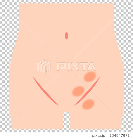 鼠径ヘルニアの種類　ヘルニア　股関節 134947971