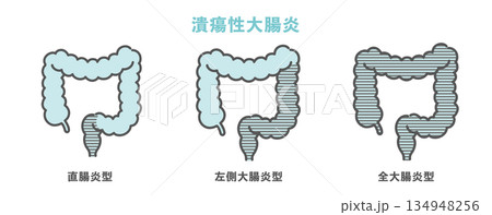 潰瘍性大腸炎の病変範囲分類（直腸炎型・左側大腸炎型・全大腸炎型） 134948256
