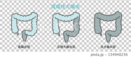 潰瘍性大腸炎の病変範囲分類（直腸炎型・左側大腸炎型・全大腸炎型） 134948256