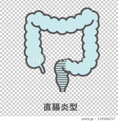 Illustration of ulcerative colitis and proctitis (lesion range) Illustration of ulcerative colitis and proctitis (lesion range) 134948257